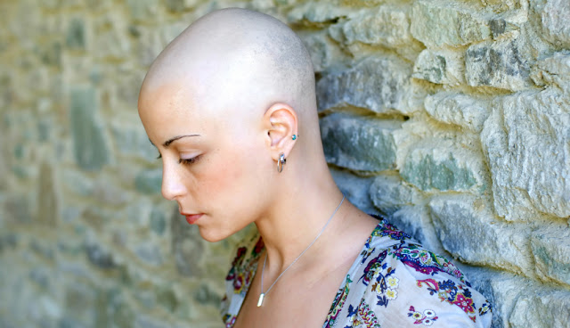 young woman with hair loss leaning against a wall
